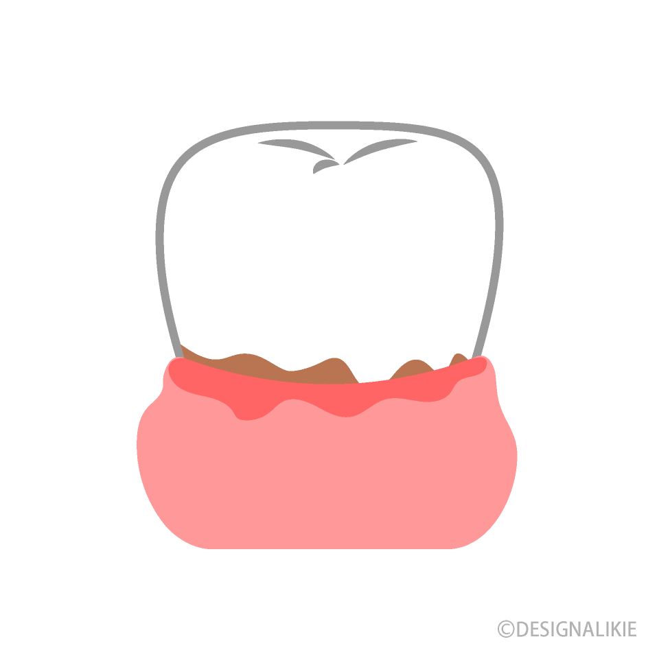 歯周病の歯の無料イラスト素材 イラストイメージ