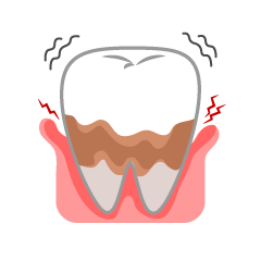 歯周病でぐらつく歯