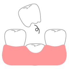 乳歯の生え変わり